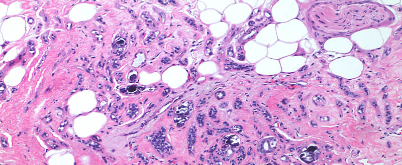 Breast Pathology